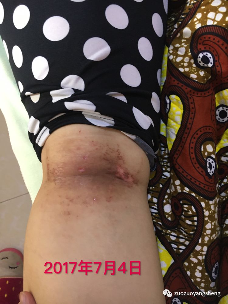 案例分享:原始点调理全身奇痒无比的湿疹案例 案例分享:原始点调理全身奇痒无比的湿疹案例