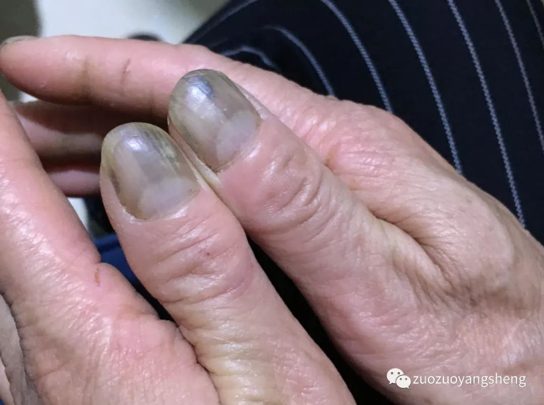 案例分享: 原始点+辟谷调理婆婆肺气肿、尘肺病的案例 案例分享: 原始点+辟谷调理婆婆肺气肿、尘肺病的案例