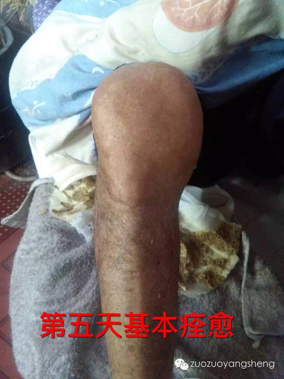 案例分享：原始点调理类风湿五天改善的案例