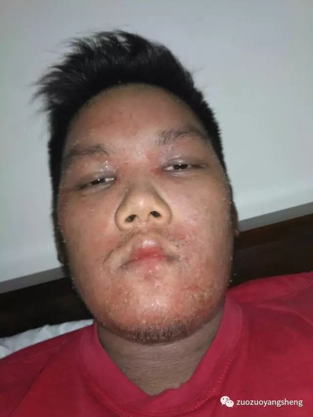 案例分享:马来西亚男孩严重湿疹,10天大变样 案例分享:马来西亚男孩严重湿疹,10天大变样