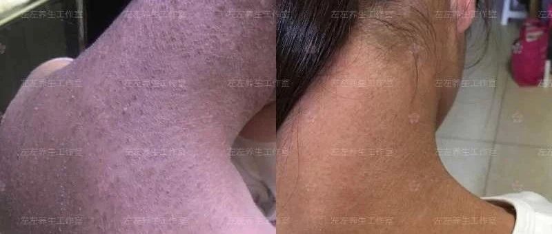 案例分享：馨心公益联合原始点公益帮助大山深处女孩调理全身干癣的案例-原始点全球同学网
