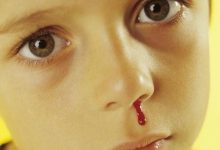 微问答140期：流鼻血是因为上火了吗？-原始点全球同学网