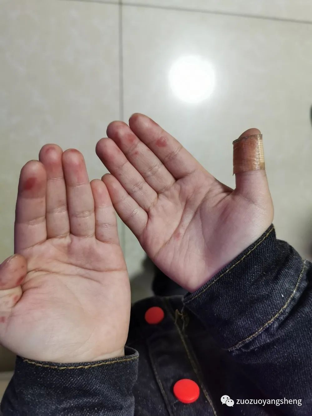 案例分享:原始点调理儿童手足口病的案例 案例分享:原始点调理儿童手足口病的案例