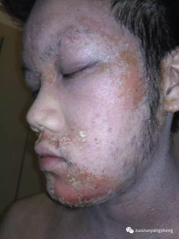 案例分享:马来西亚男孩严重湿疹,10天大变样 案例分享:马来西亚男孩严重湿疹,10天大变样