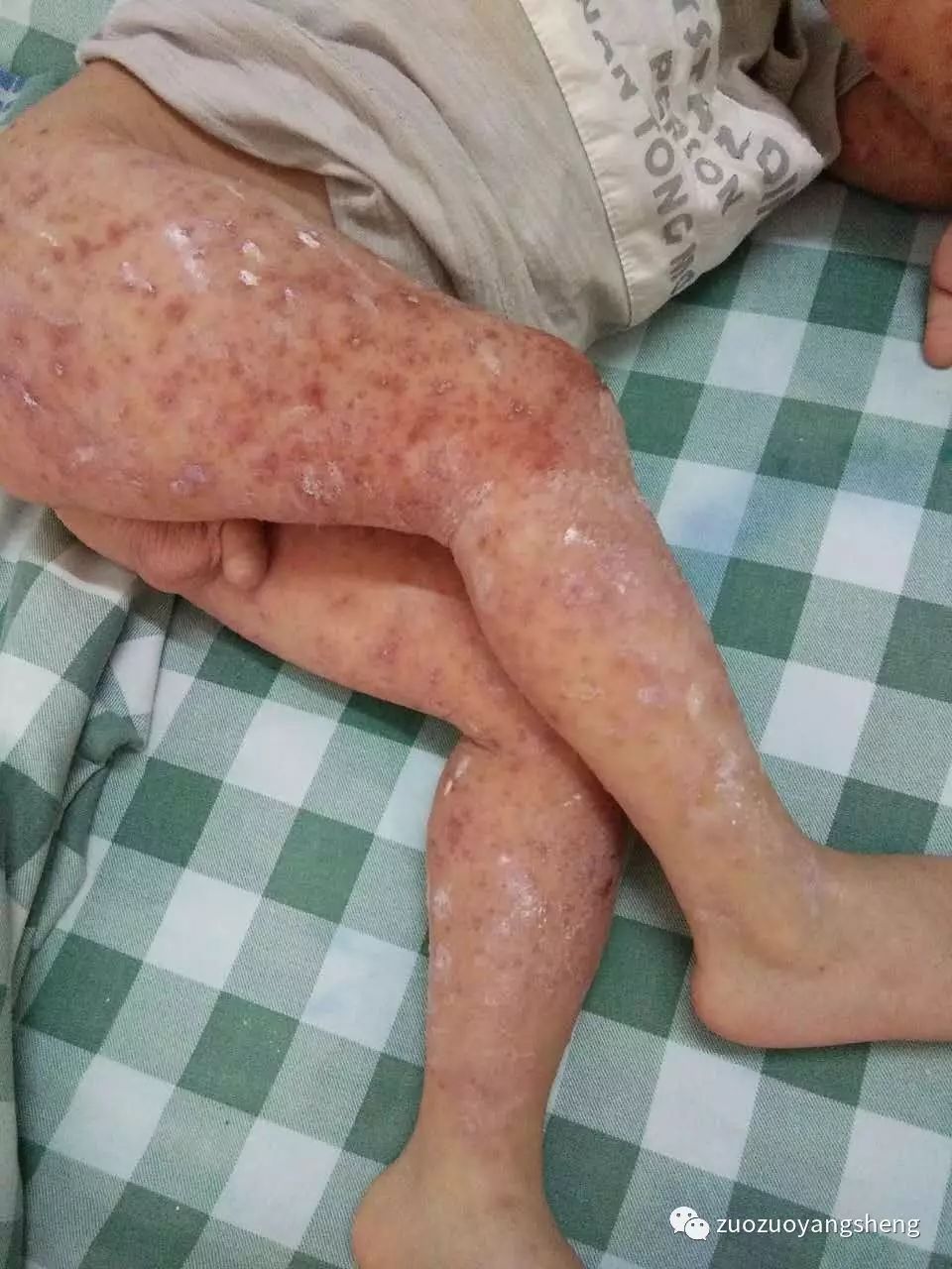 原始点调理幼儿咳嗽后出现严重好转反应