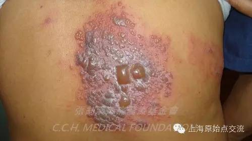 案例分享:原始点调理带状疱疹的案例 案例分享:原始点调理带状疱疹的案例