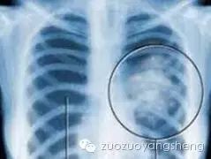 案例分享：肺癌真的需要开刀吗？肺癌晚期而且多处骨转移，经过原始点调理一年多肿瘤缩小三分之二。-原始点全球同学网