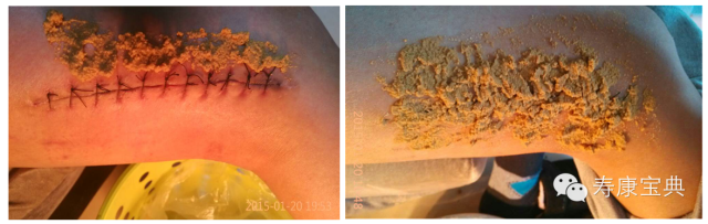 案例分享:原始点调理骨折手术后的恢复 案例分享:原始点调理骨折手术后的恢复