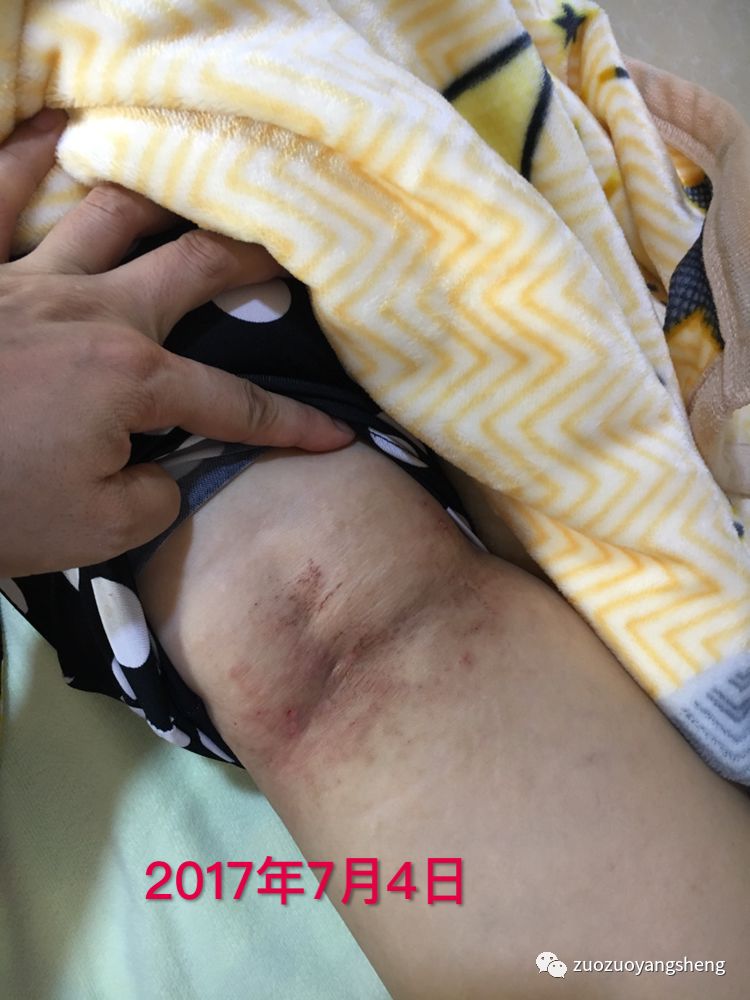 案例分享:原始点调理全身奇痒无比的湿疹案例 案例分享:原始点调理全身奇痒无比的湿疹案例