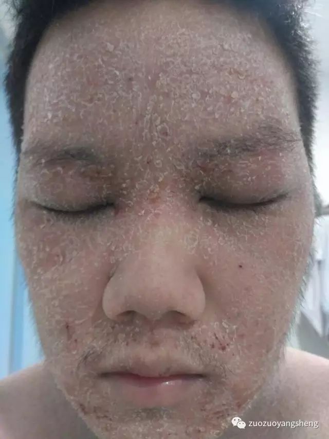 案例分享:马来西亚男孩严重湿疹,10天大变样 案例分享:马来西亚男孩严重湿疹,10天大变样