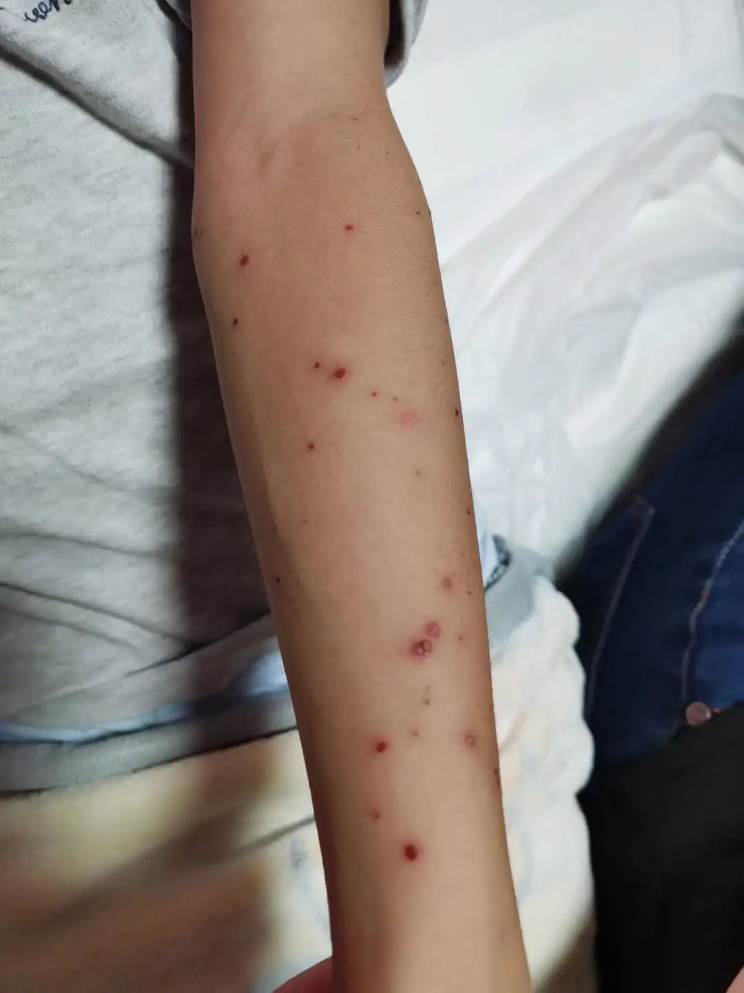 案例分享:原始点调理孩子水痘案例 案例分享:原始点调理孩子水痘案例