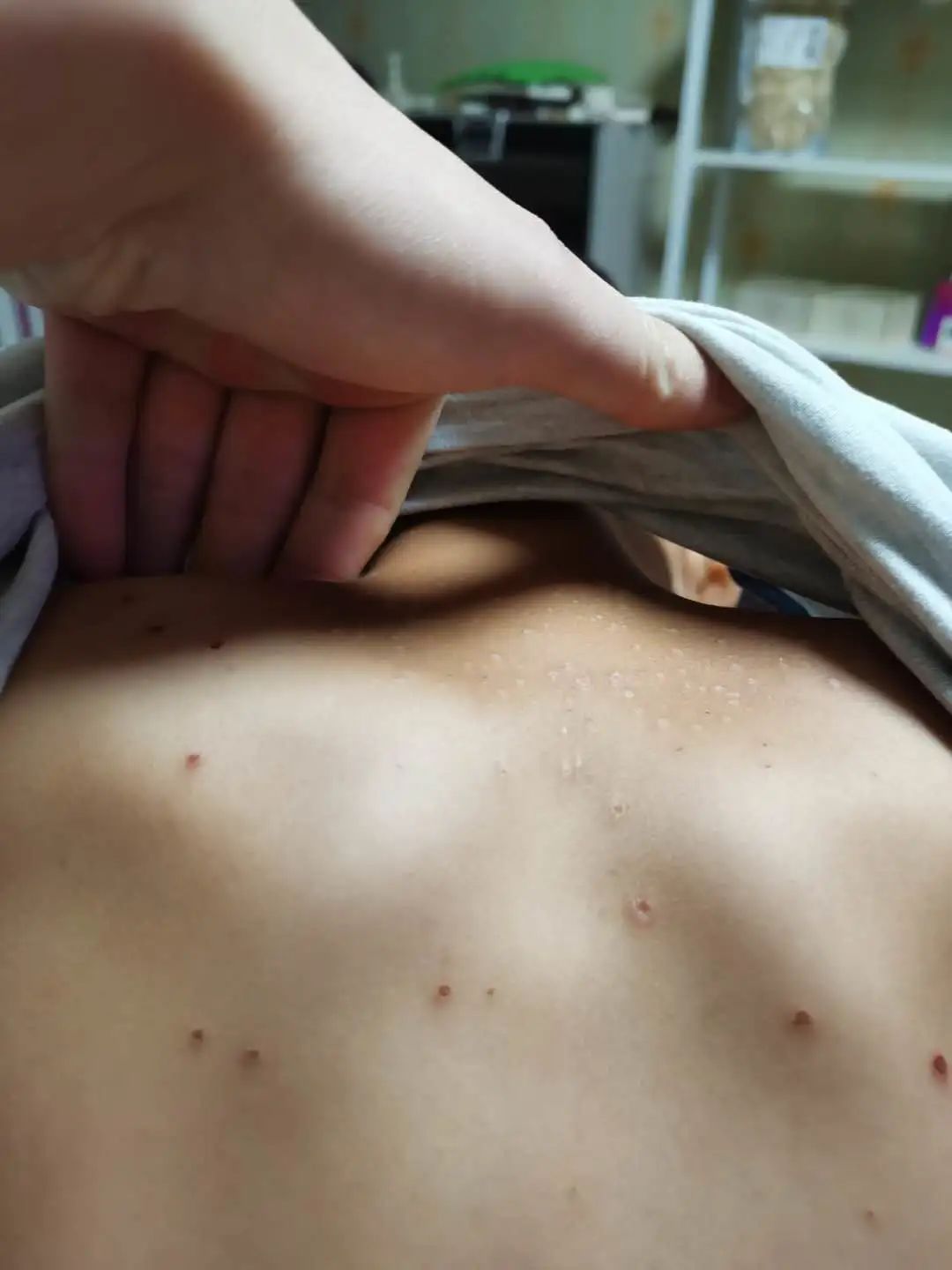 案例分享:原始点调理孩子水痘案例 案例分享:原始点调理孩子水痘案例