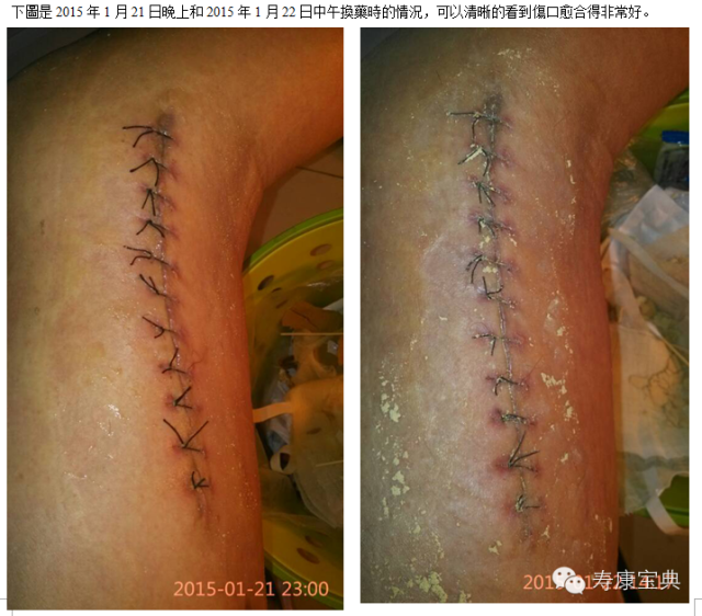 案例分享:原始点调理骨折手术后的恢复 案例分享:原始点调理骨折手术后的恢复