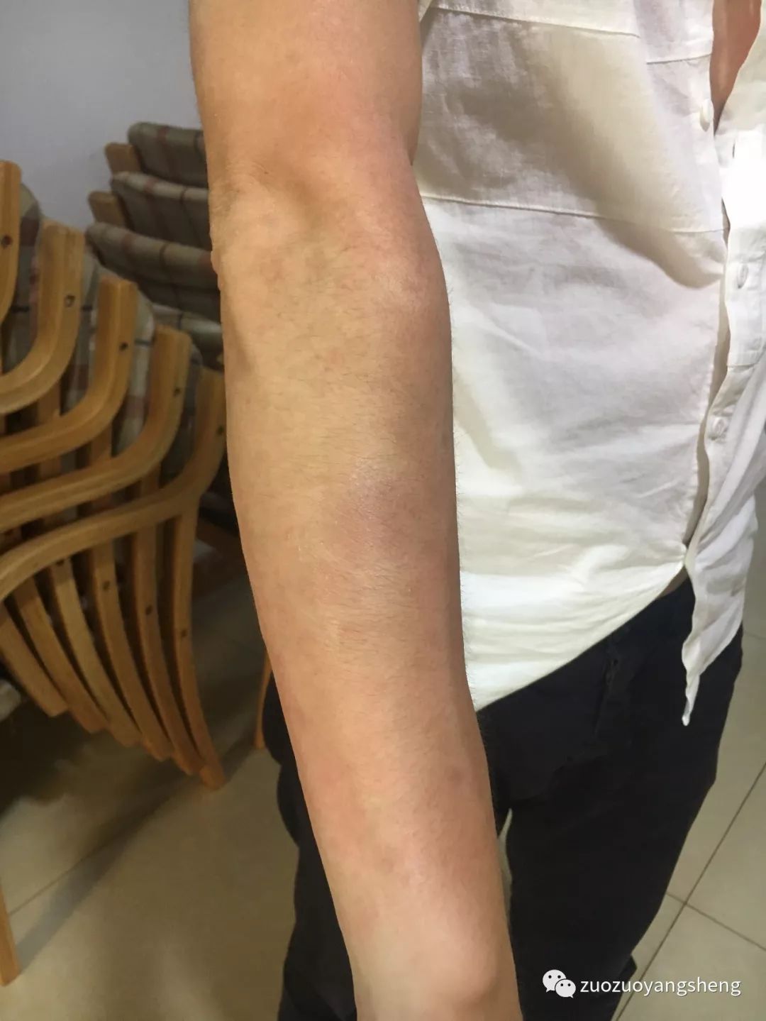 案例分享:原始点调理十几年牛皮癣的案例 案例分享:原始点调理十几年牛皮癣的案例