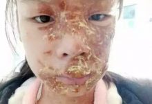 案例分享:原始点调理花季少女面部烫伤不留疤的案例-原始点全球同学网