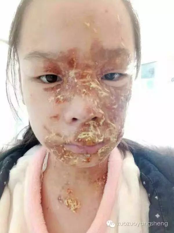 案例分享：原始点调理花季少女面部烫伤不留疤的案例-原始点全球同学网