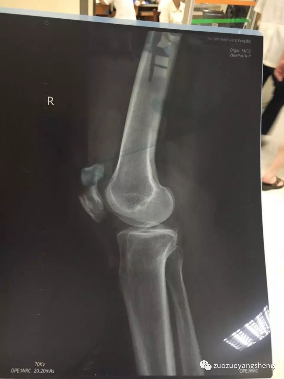 案例分享:最难度的家人——原始点调理妈妈骨折手术后的康复 案例分享:最难度的家人——原始点调理妈妈骨折手术后的康复