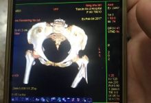 原始点续写又一奇迹：83岁婆婆骨折错位没开刀没手术，6周康复-原始点全球同学网