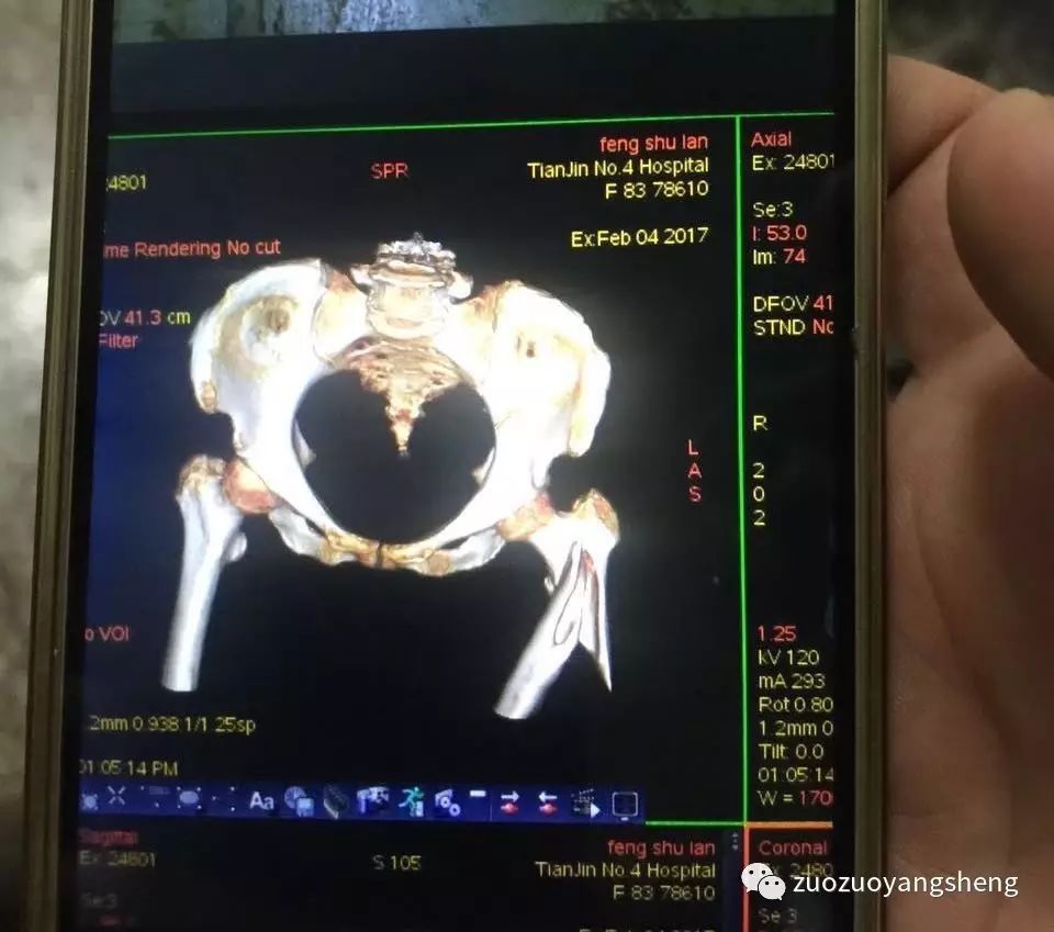 原始点续写又一奇迹：83岁婆婆骨折错位没开刀没手术，6周康复-原始点全球同学网