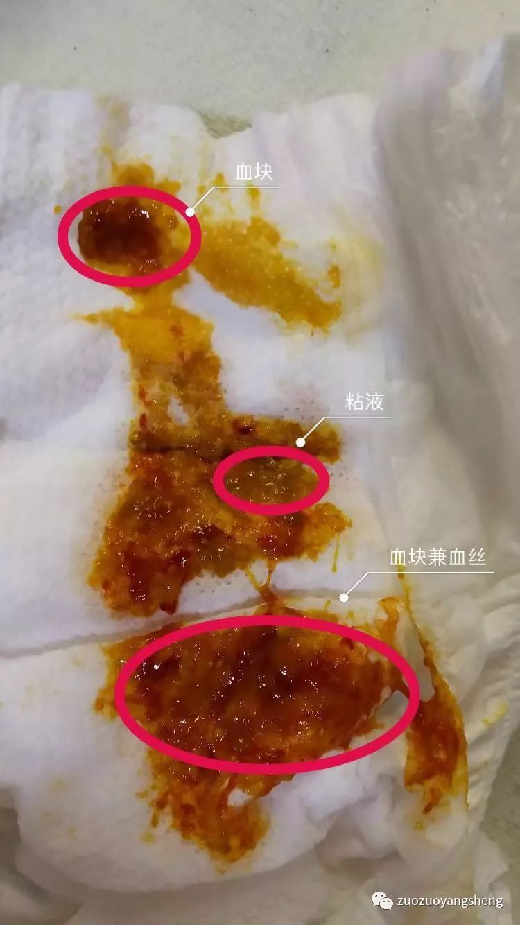 案例分享:原始点调理三个月宝宝腹泻、便血的案例 案例分享:原始点调理三个月宝宝腹泻、便血的案例