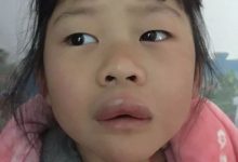 案例分享：原始点调理新年“食物中毒”的案例-原始点全球同学网