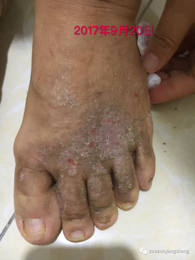 案例分享:原始点调理全身奇痒无比的湿疹案例 案例分享:原始点调理全身奇痒无比的湿疹案例