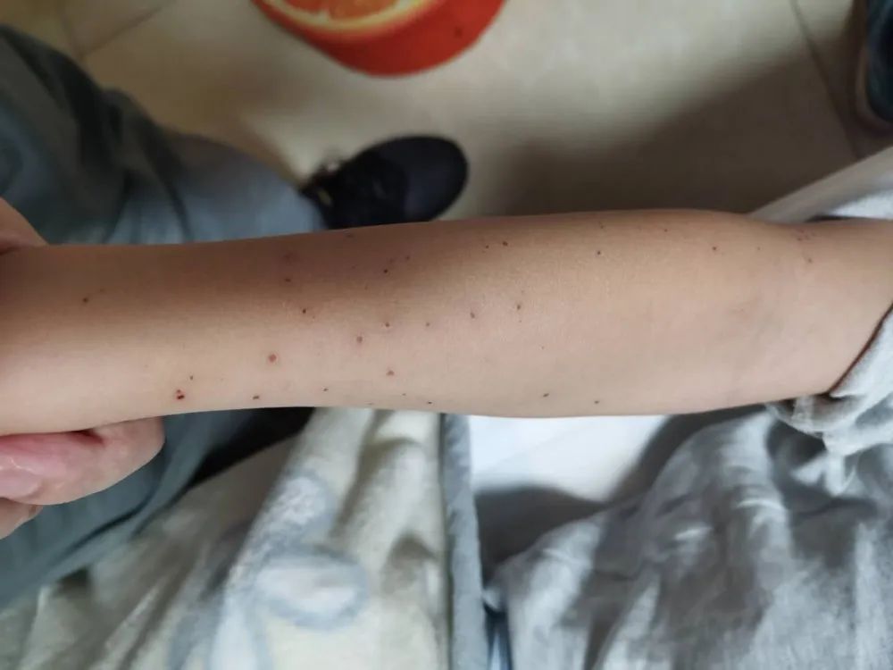 案例分享:原始点调理孩子水痘案例 案例分享:原始点调理孩子水痘案例