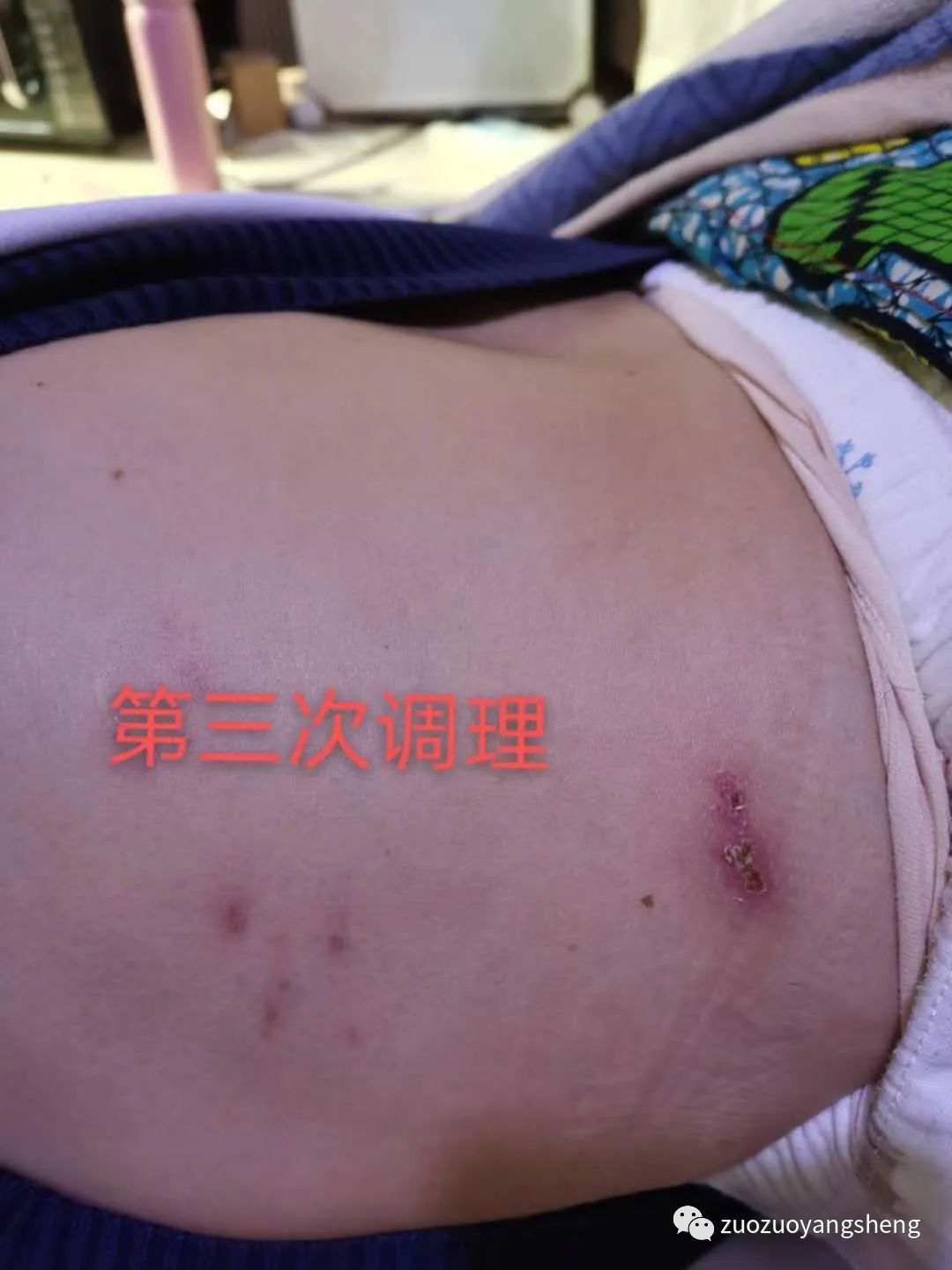 案例分享:原始点调理带状疱疹两次后结痂脱落案例 案例分享:原始点调理带状疱疹两次后结痂脱落案例