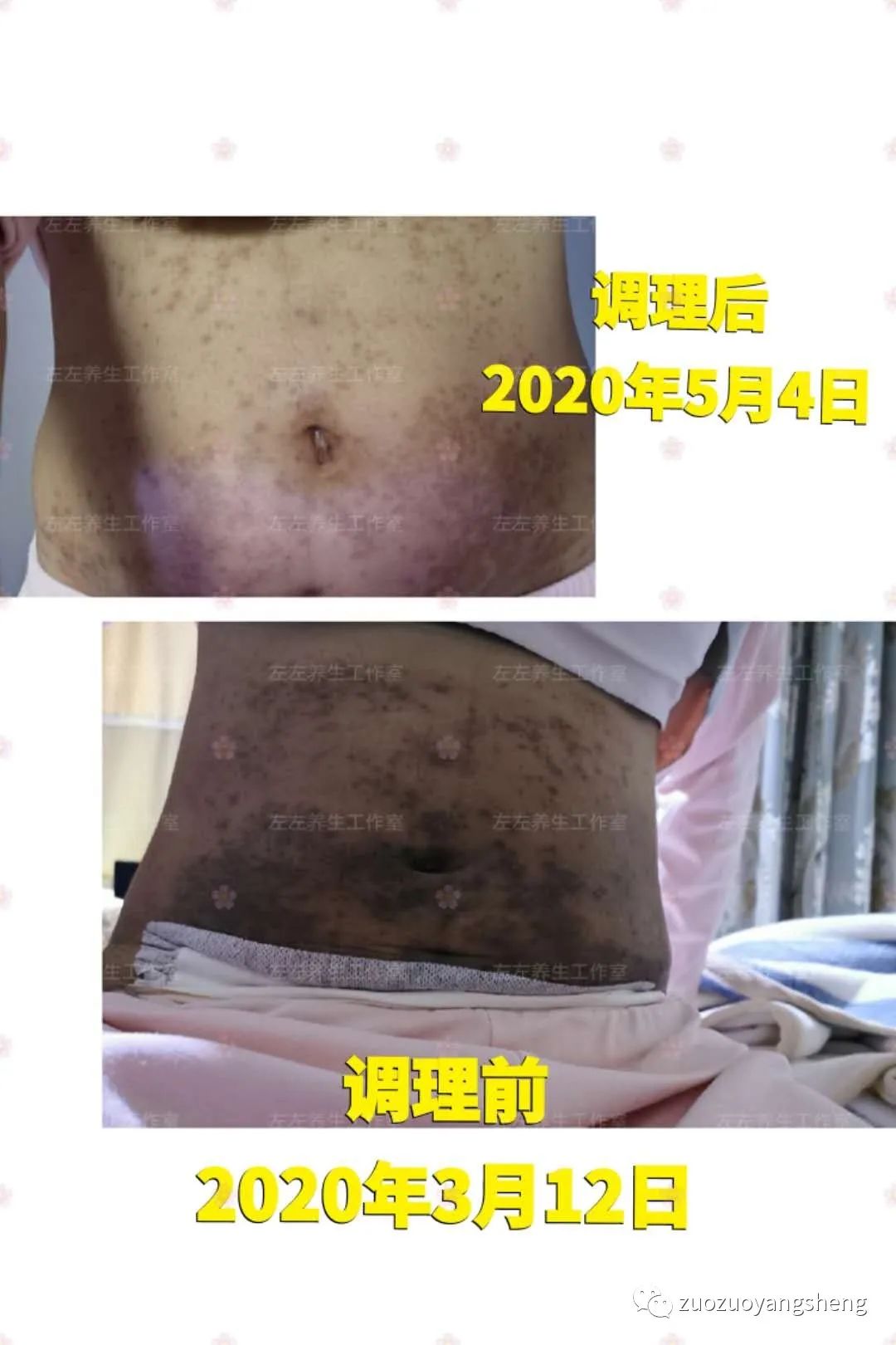 案例分享:原始点调理产后高血压,全身奇痒无比案例 案例分享:原始点调理产后高血压,全身奇痒无比案例