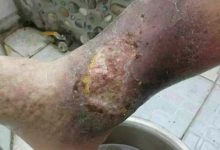 案例分享：原始点调理20年伤口不愈合的案例-原始点全球同学网