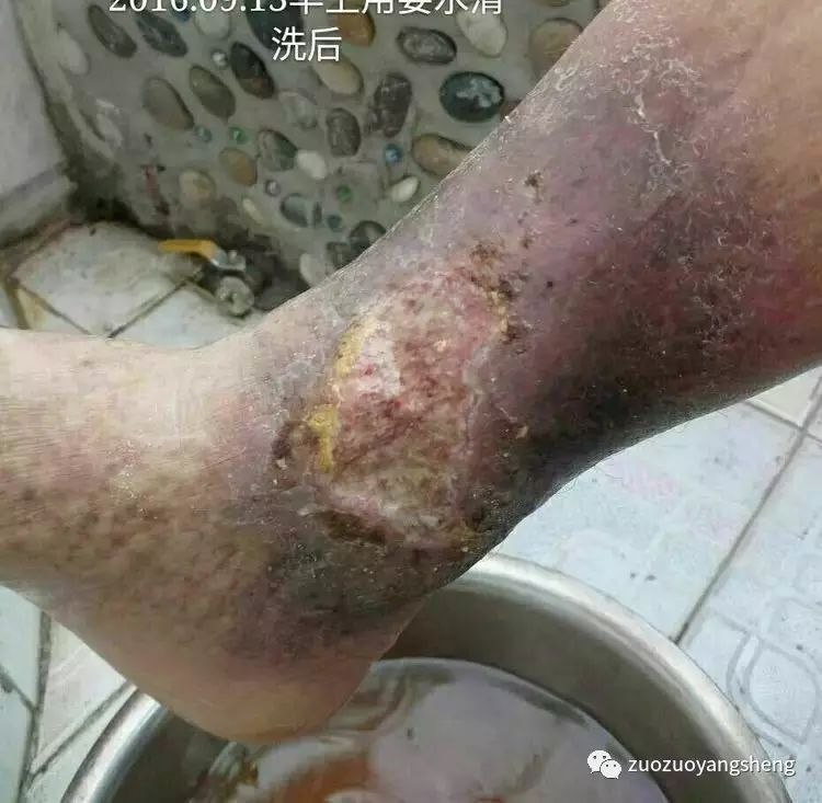 案例分享：原始点调理20年伤口不愈合的案例-原始点全球同学网