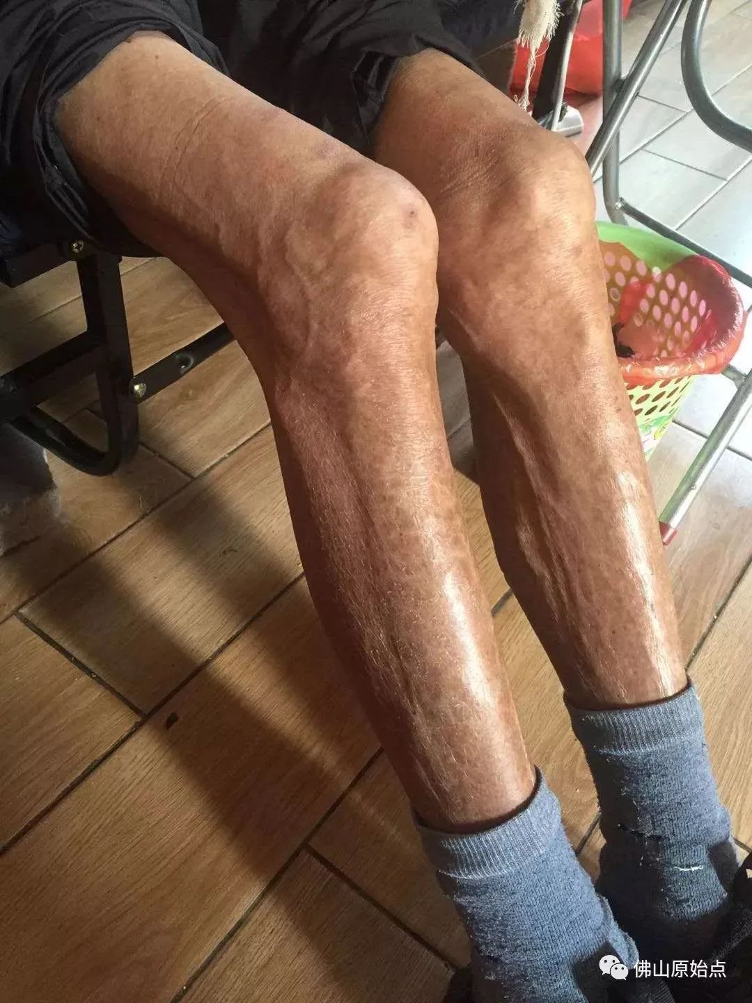 原始点调理肺肿瘤案例 原始点调理肺肿瘤案例