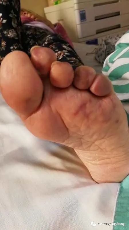 微问答177期:孩子3年前做过开颅手术,术后右侧肢体偏瘫,19年癫痫发作过两次…… 微问答177期:孩子3年前做过开颅手术,术后右侧肢体偏瘫,19年癫痫发作过两次……