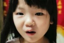 案例分享:原始点调理儿童腮腺炎的案例-原始点全球同学网