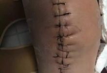 案例分享：最难度的家人——原始点调理妈妈骨折手术后的康复-原始点全球同学网