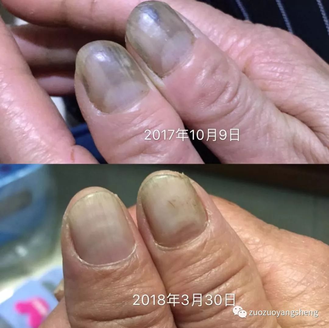 案例分享: 原始点+辟谷调理婆婆肺气肿、尘肺病的案例 案例分享: 原始点+辟谷调理婆婆肺气肿、尘肺病的案例