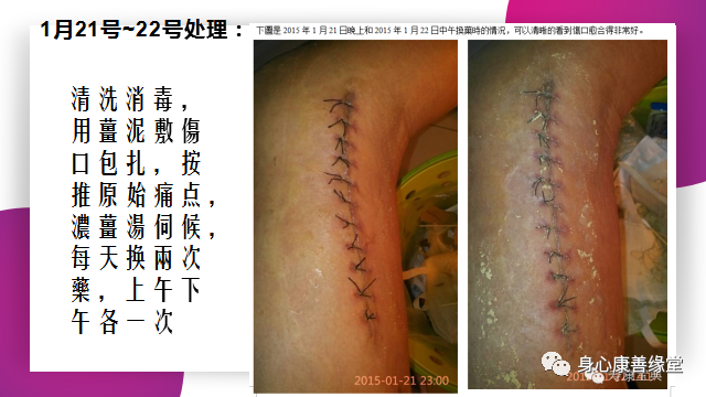 原始點:腿伤术后康复记 原始點:腿伤术后康复记