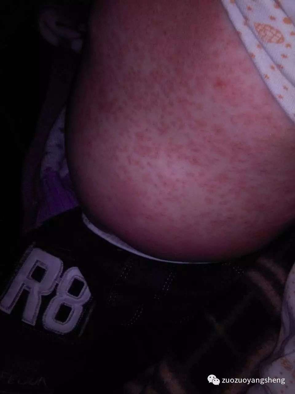 案例分享：原始点调理小朋友的婴幼儿急疹案例