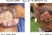 乳癌七天大幅改善案例(46岁辛巴威)(简体版)-原始点全球同学网