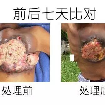 乳癌七天大幅改善案例（46岁辛巴威）（简体版）-原始点全球同学网