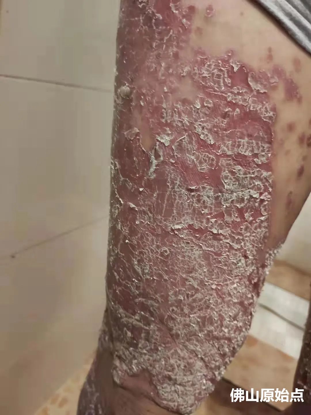 原始点调理十年牛皮癣案例 原始点调理十年牛皮癣案例