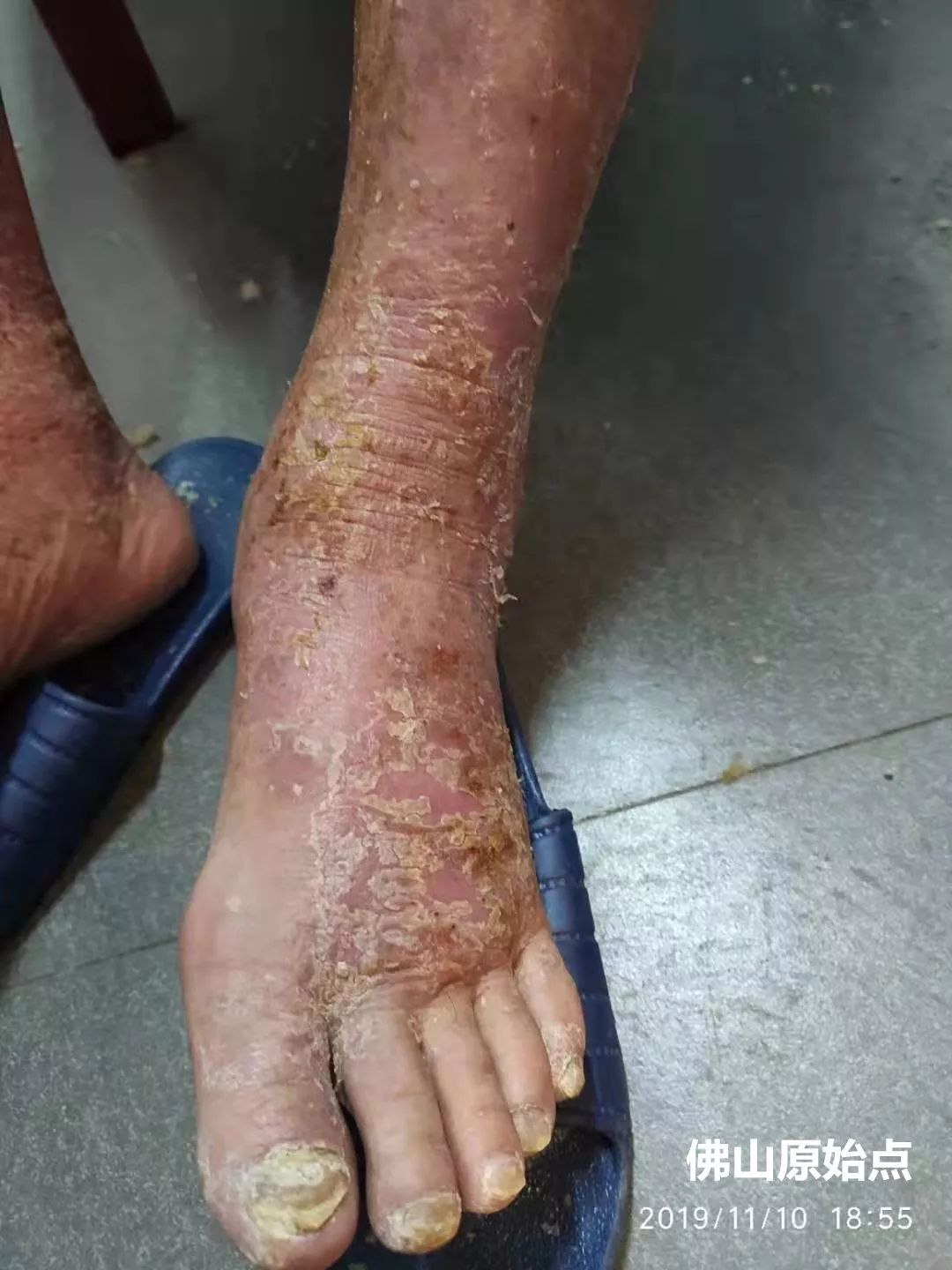 原始点调理十年牛皮癣案例 原始点调理十年牛皮癣案例