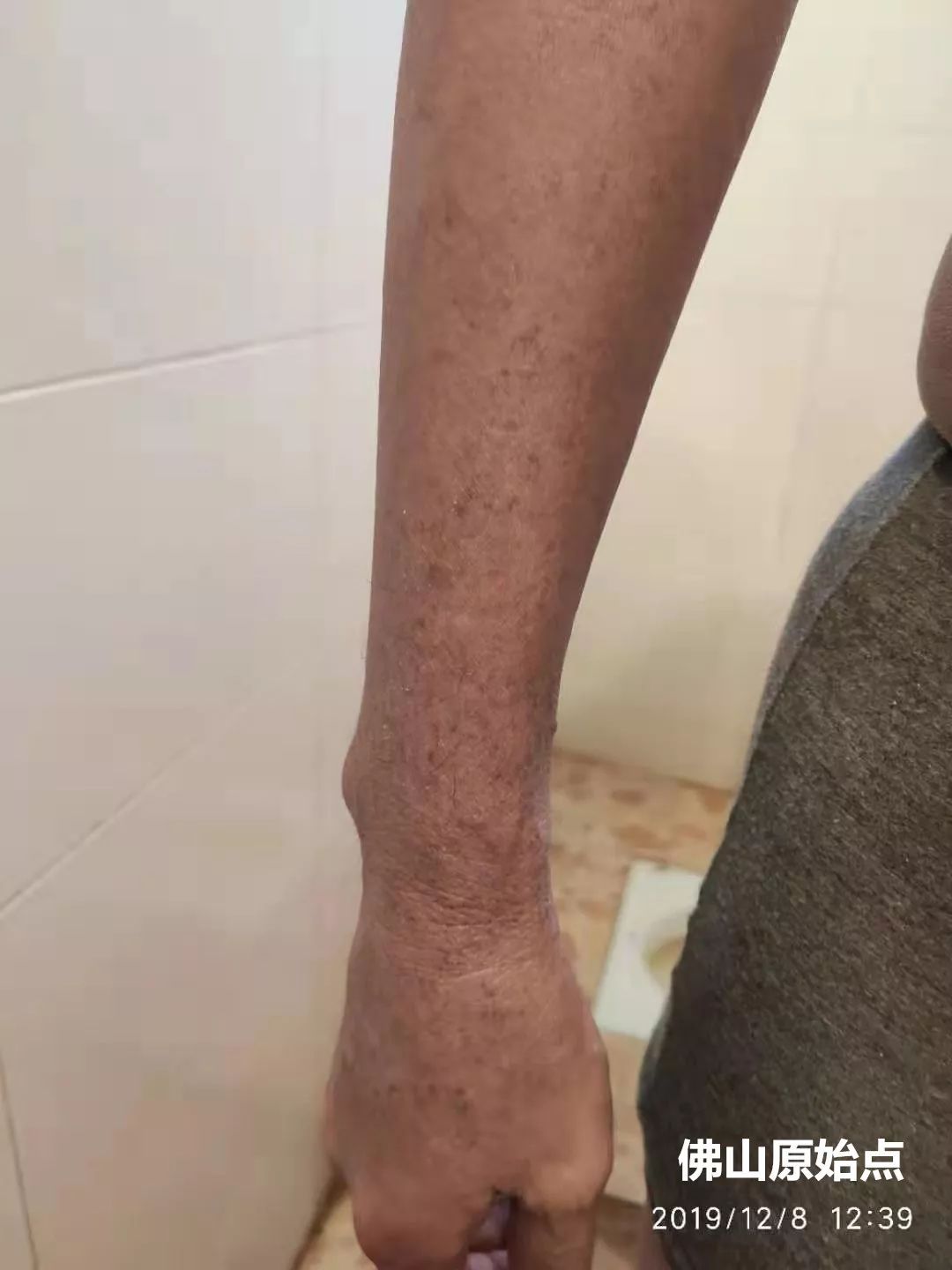 原始点调理十年牛皮癣案例 原始点调理十年牛皮癣案例