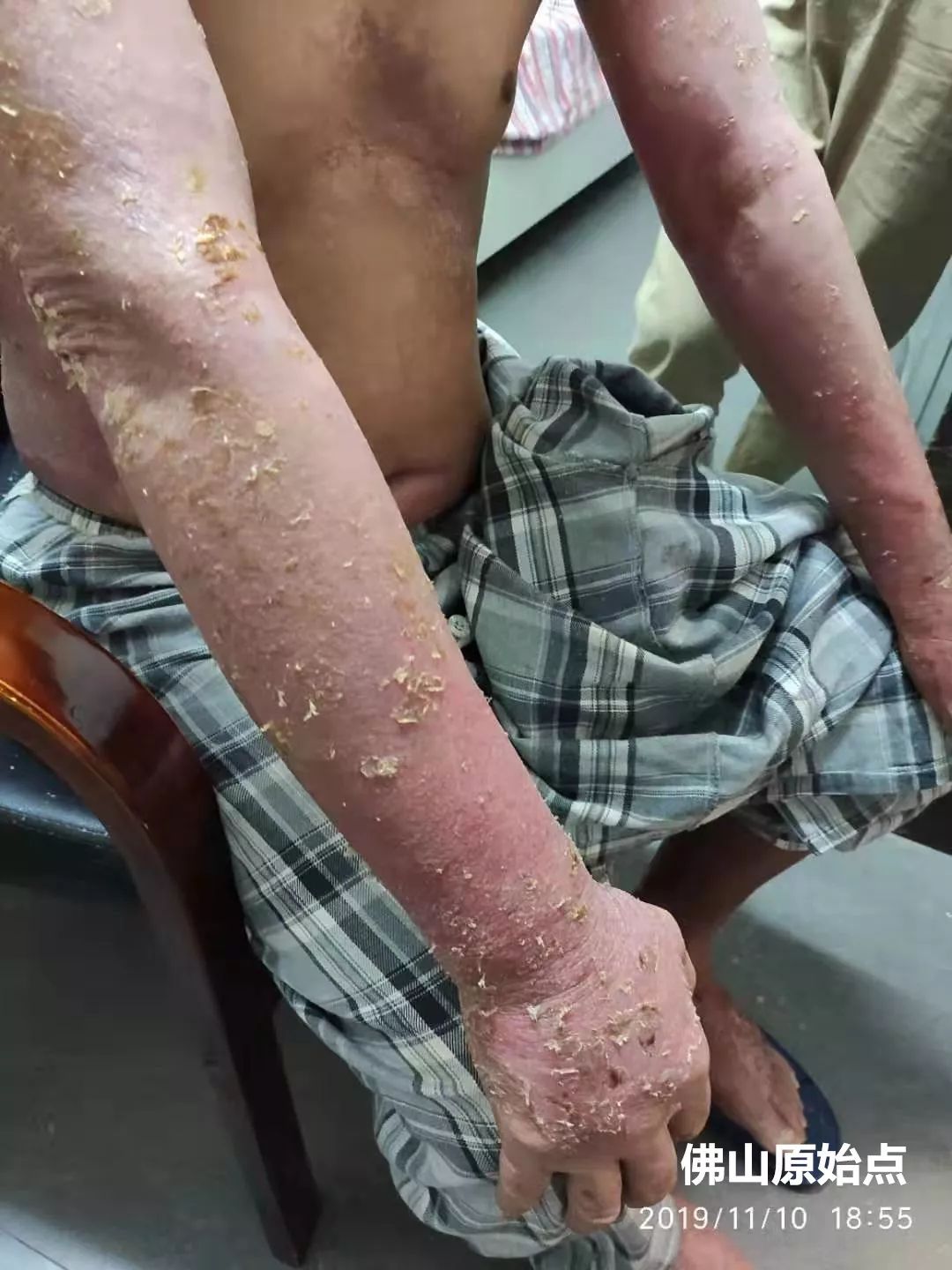 原始点调理十年牛皮癣案例 原始点调理十年牛皮癣案例