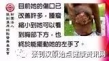 乳癌案例(46岁辛巴威)-原始点全球同学网