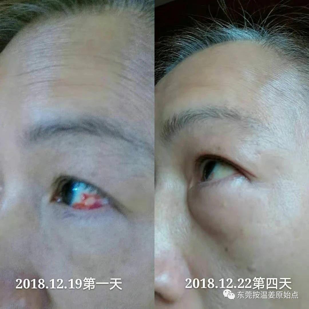 眼睛红2例-原始点全球同学网
