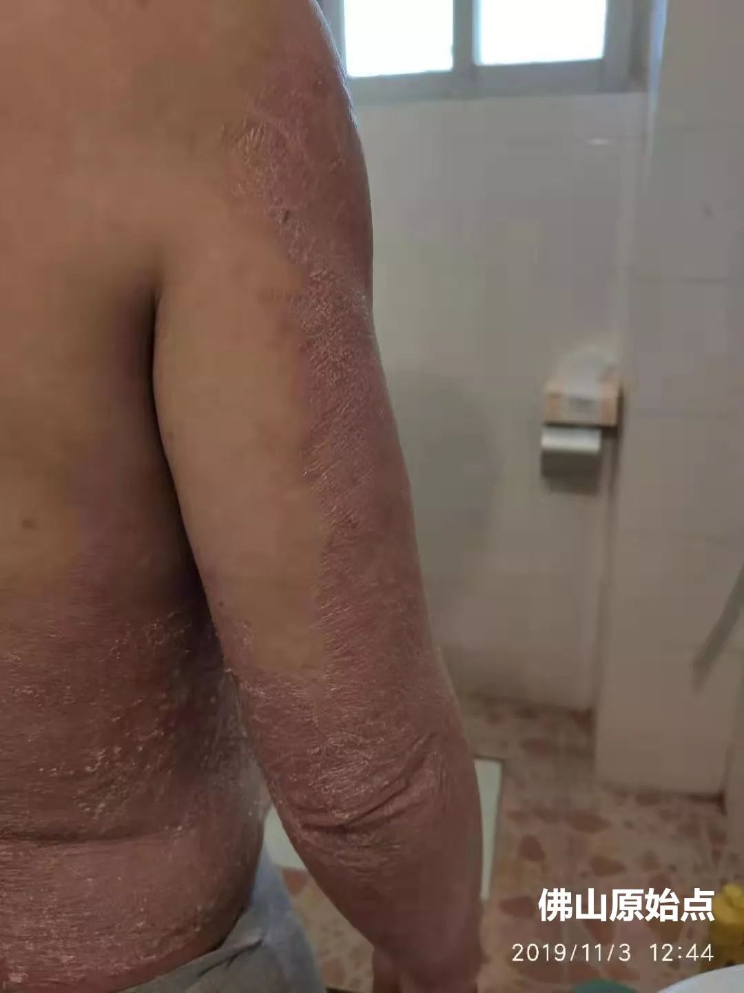 原始点调理十年牛皮癣案例 原始点调理十年牛皮癣案例