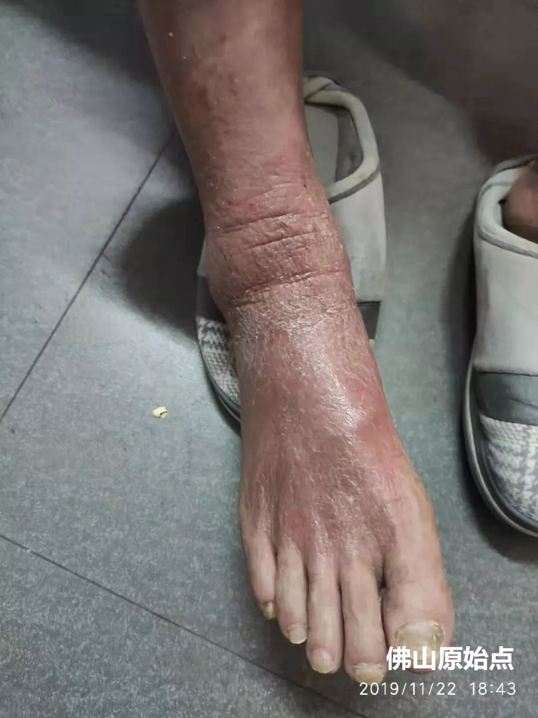 原始点调理十年牛皮癣案例 原始点调理十年牛皮癣案例