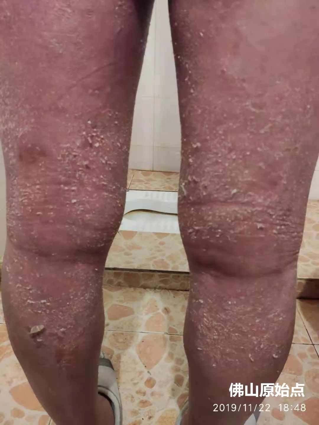 原始点调理十年牛皮癣案例 原始点调理十年牛皮癣案例