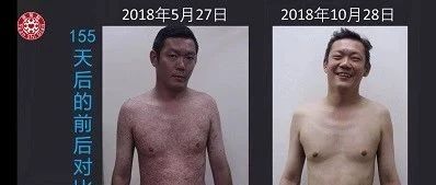 牛皮癣案例2018（马来西亚）多年牛皮癣原始点调理155天完全恢复-原始点全球同学网